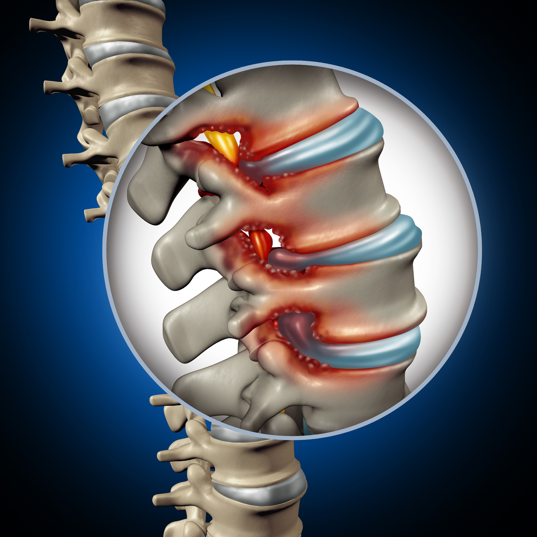 Grafik einer Spinalkanalstenose.